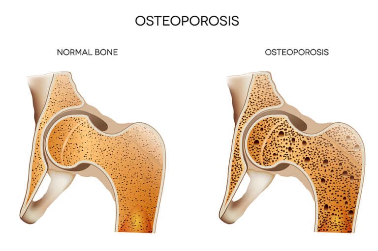 Home care helps seniors with osteoporosis stay active, prevent falls, and protect bones.